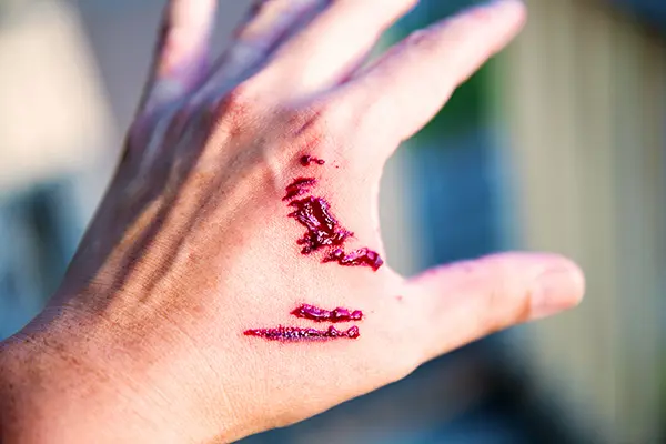 insurance claims in dog bite cases lawyer in bergen county